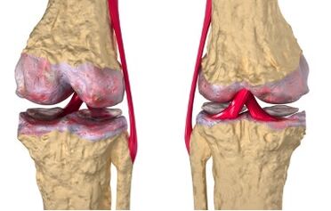 Varices du développement de la gonarthrose