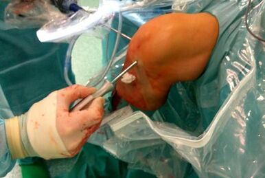 Intervention chirurgicale sur l'arthrose