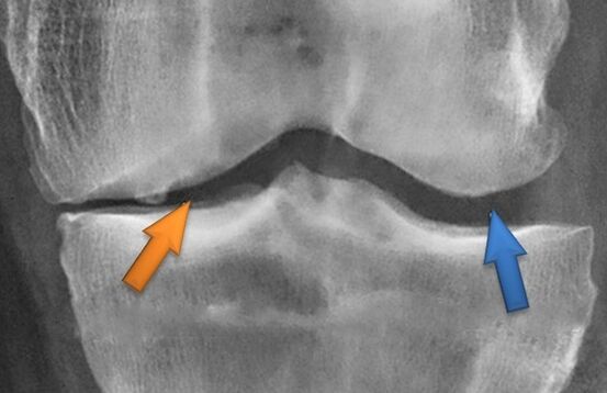 Kineteithetorapie pour l'arthrose